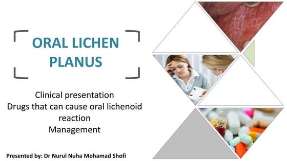Oral lichen planus | PPTX