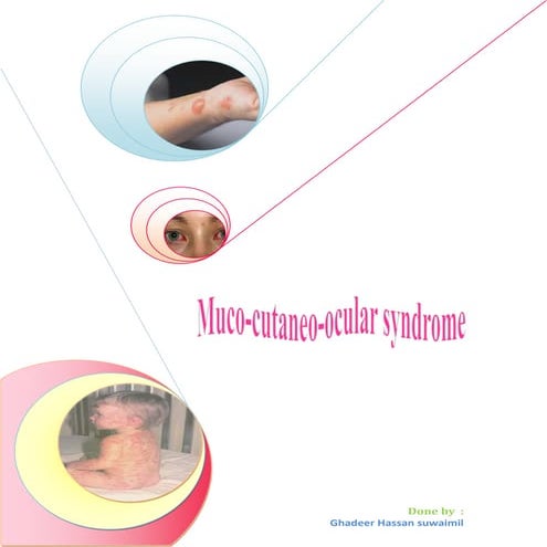 Muco-cutaneo-ocular syndrome