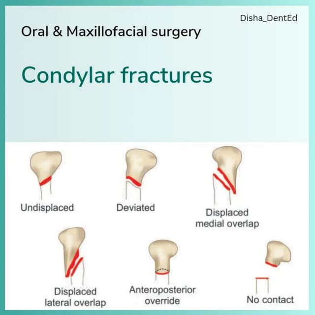 Oral Surgery_ Condylar Fractures.pdfhdjdiidkkdkd | PDF