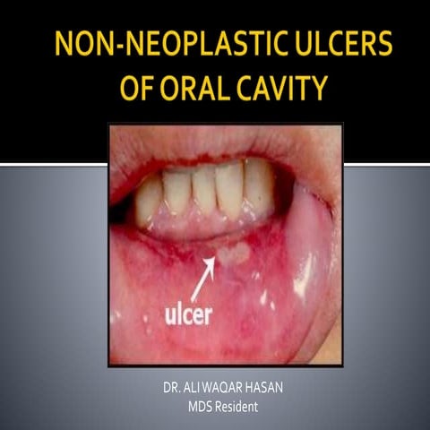 Oral ulcers