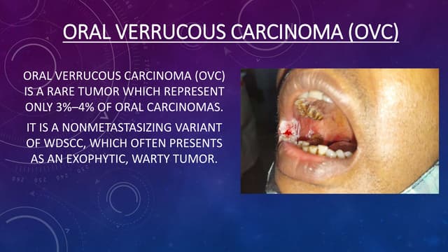 Verrucous Carcinoma Of The Tongue