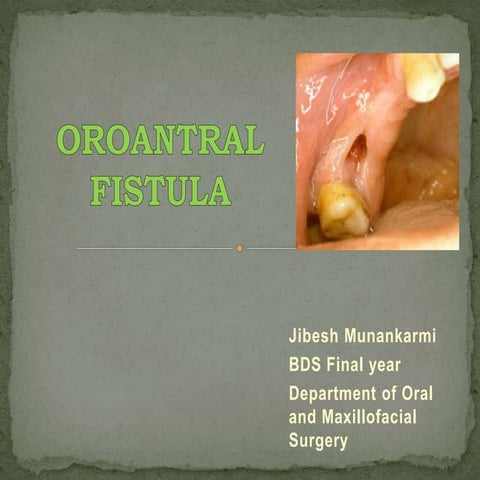 Oroantral Fistula