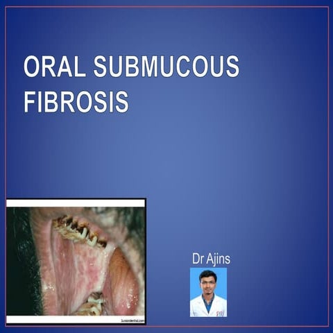 Oral submucous fibrosis