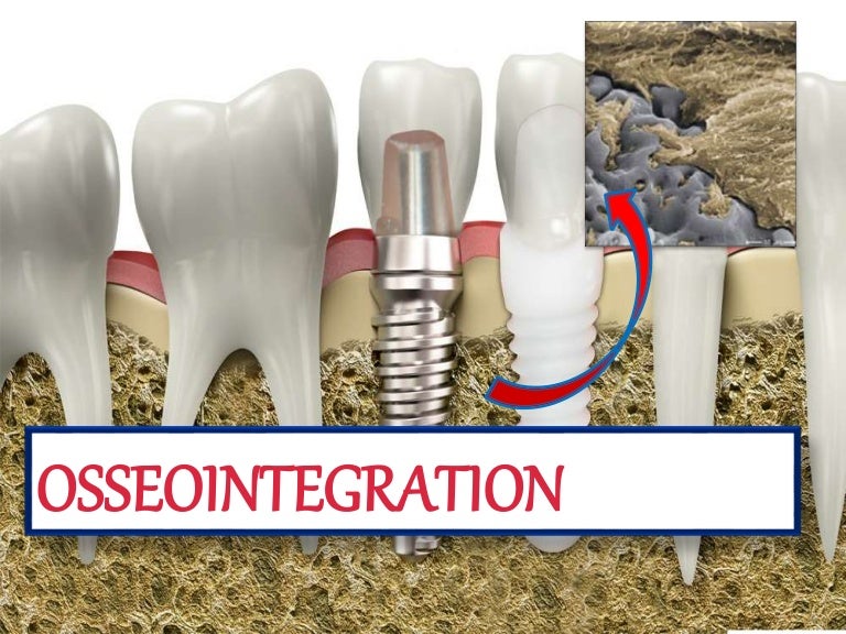"OSSEOINTEGRATION"