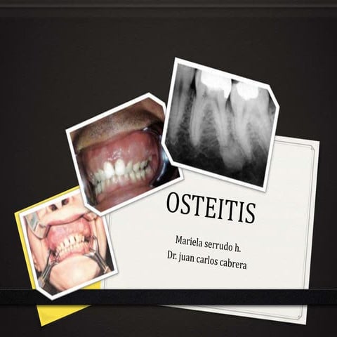 Osteitis mariela | PPTX