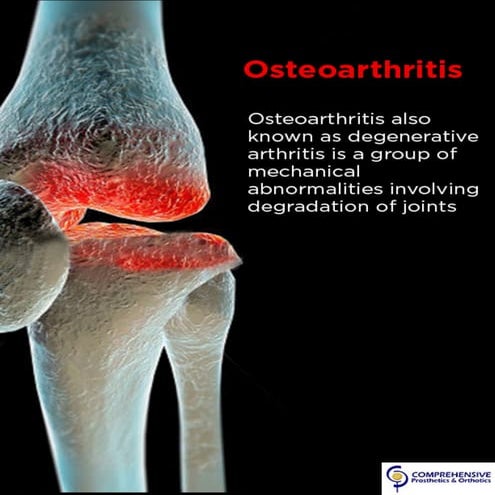 Osteoarthritis