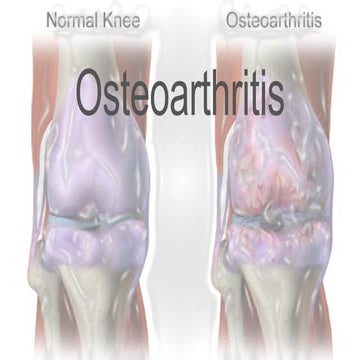 Power point Osteoarthritis definisi, manajemen tatalaksana