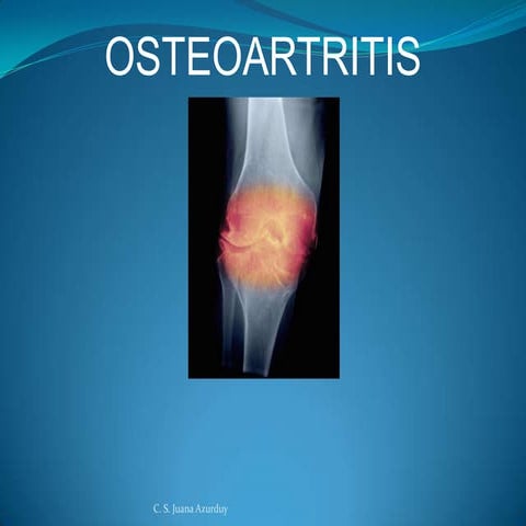 Osteoartrosis