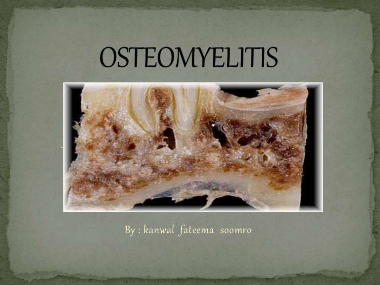 Osteomyelitis