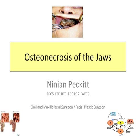 Osteonecrosis of the jaws