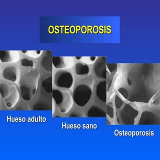 Osteoporosis