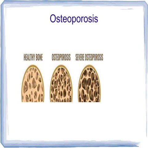 Osteoporosis