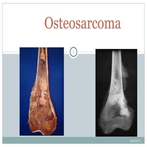 Osteosarcoma[2]
