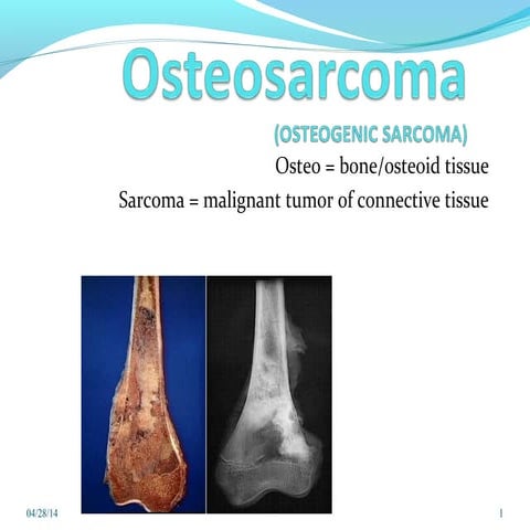 Osteosarcoma ppt