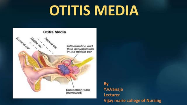 Otitis media