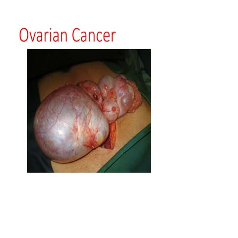 Ovarian carcinoma