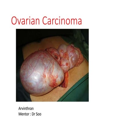 Ovarian carcinoma