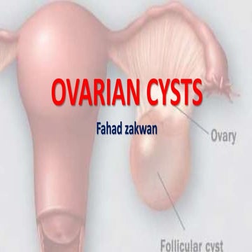 Ovarian cysts