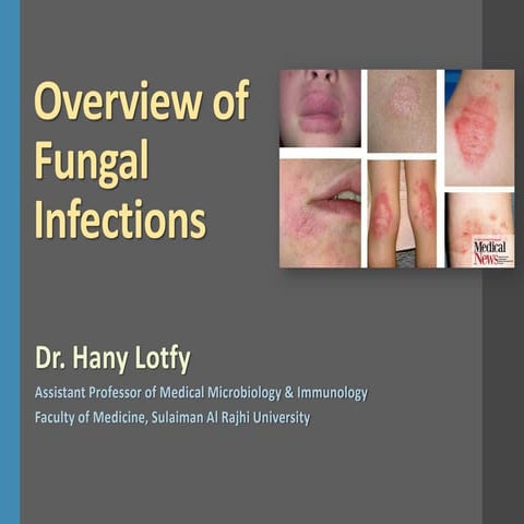 Overview of Fungal Infections