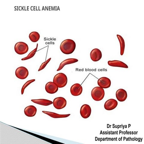 Comprehensive Overview of Sickle Cell Anemia: Pathophysiology, Clinical ...