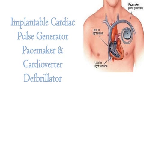 Comprehensive Overview of anaesthesia care in Implantable Cardiac ...