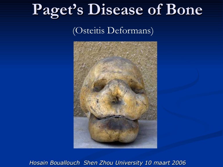Paget’S Disease Of Bone