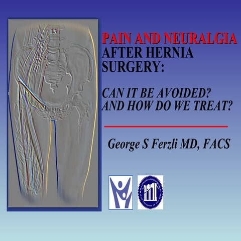 Pain and Neuralgia After Hernia Surgery: Can It Be Avoided? And How Do