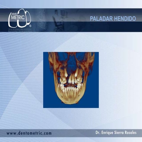Paladar hendido, | PPT