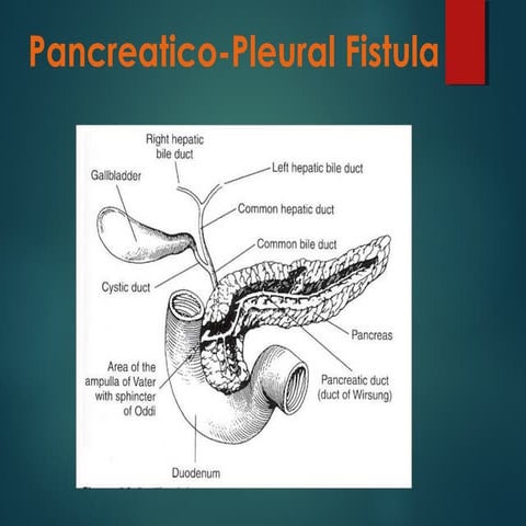 Pancreatico pleural fistula | PPT
