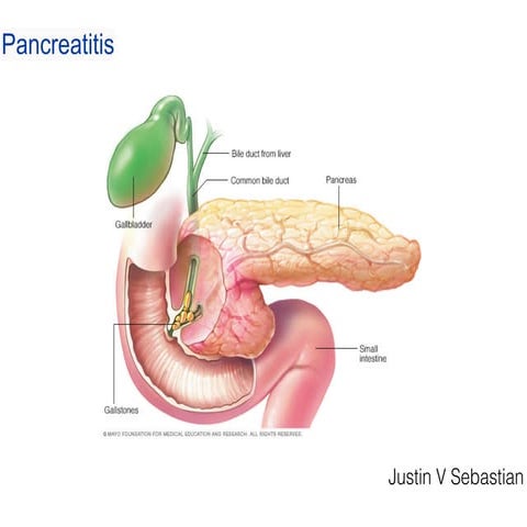Pancreatitis