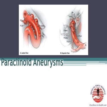 Paraclinoid aneurysms