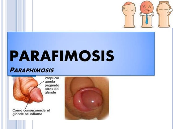 128974523 fimosis-parafimosis | PPTX