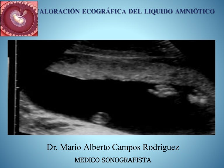 agenesia renal bilateral causa de muerte