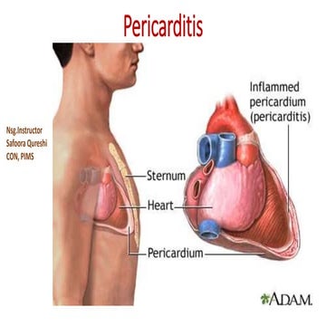 Pericarditis | PPTX