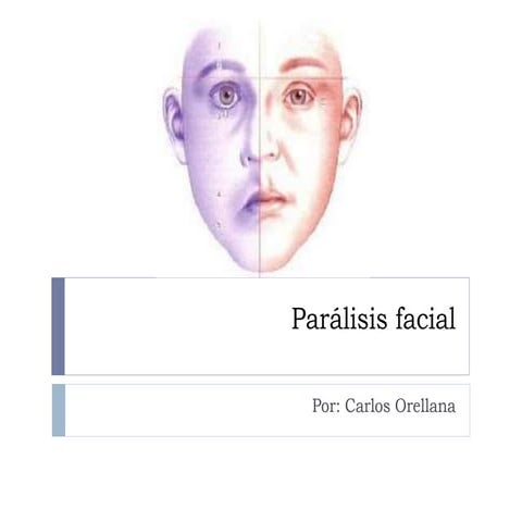 Parálisis facial