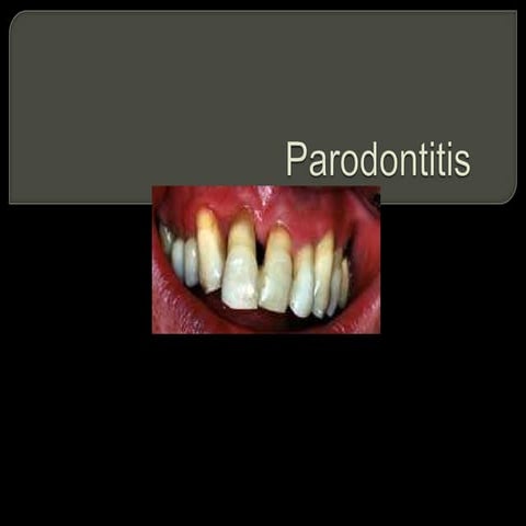 Parodontitis | PPT