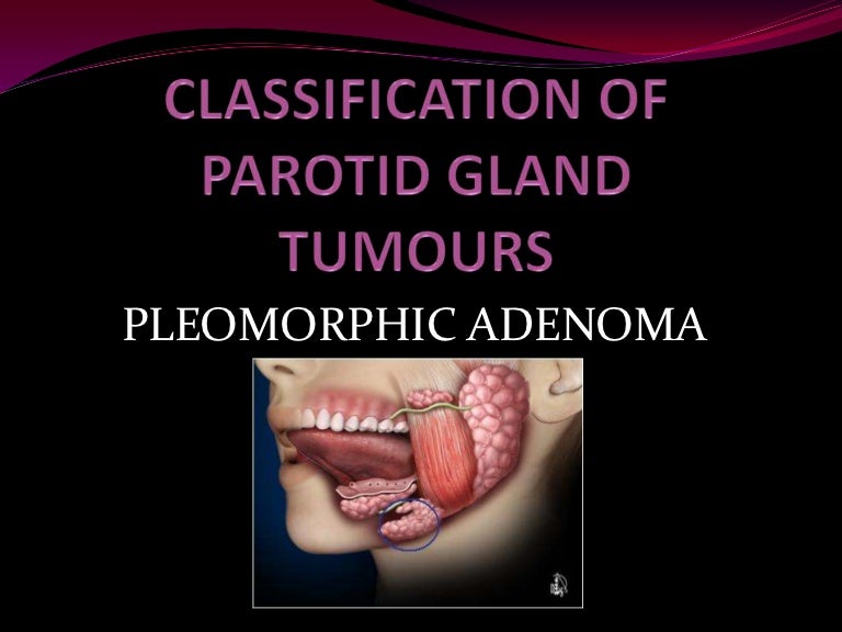 pleomorphic adenoma