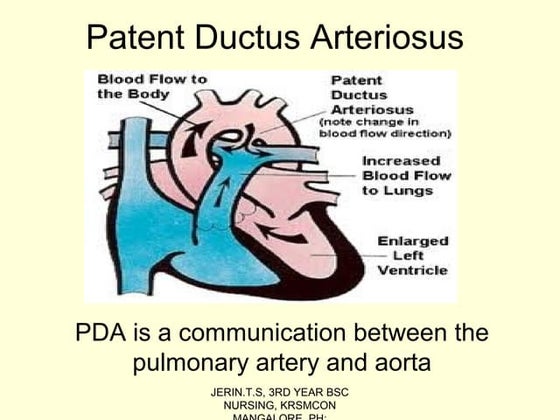 Ventricular Septal Defect with Nursing Management | PPT