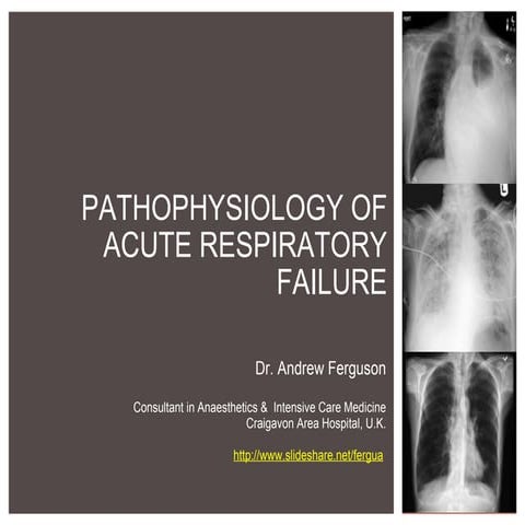 Pathophysiology of hypoxic respiratory failure