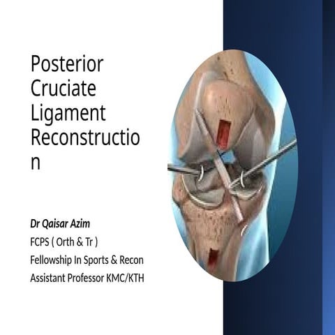 Posterior Cruciate Ligament Injury | PPT