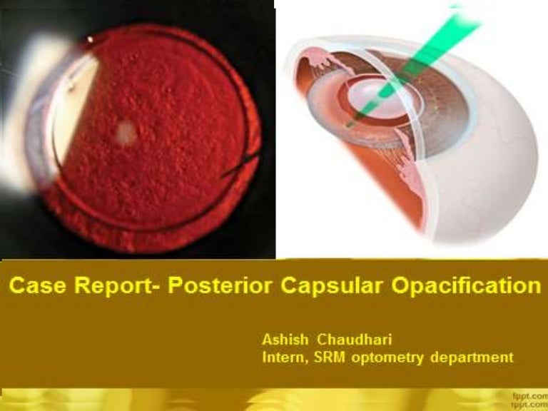 Posterior capsular opacification