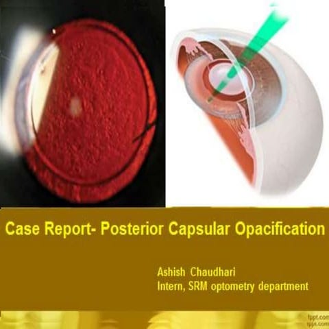 Posterior capsular opacification