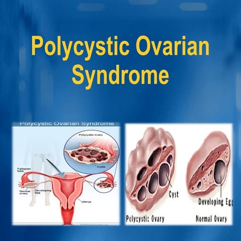 PCOD (Polycystic Ovarian Disease) | PPT