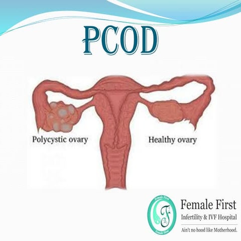 Pcod presentation converted | PDF