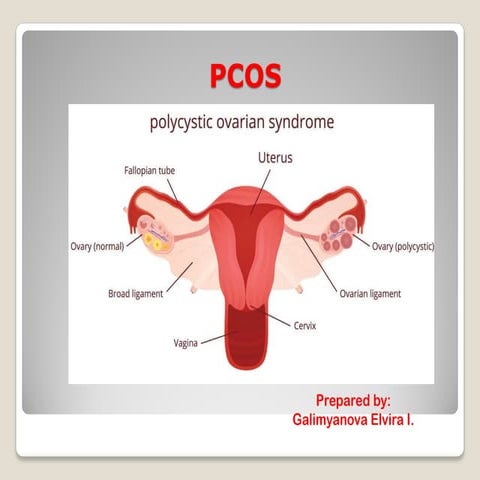 Polycystic Ovary Syndrome (PCOS) | PDF