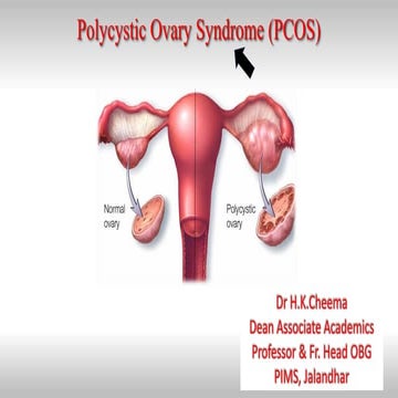 PCOS: Diagnosis and Management-HK.Cheema | PDF