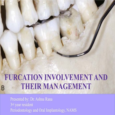 ashna Furcation involvement and their management.pdf