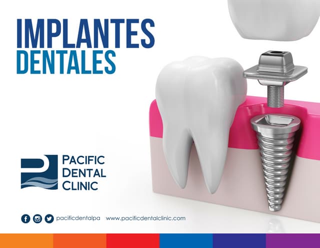 Implantes Dentales -Pacific Dental Clinic