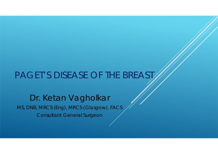 Paget's Disease of the Breast