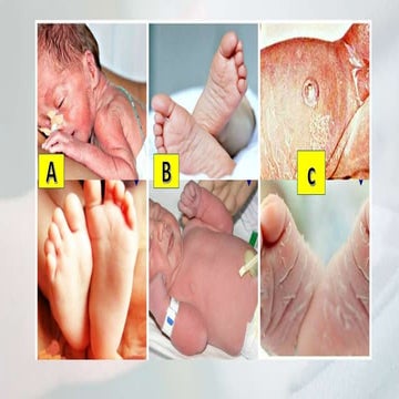 Nursing management of Preterm, Term, Post-term and IUGR Baby.pptx